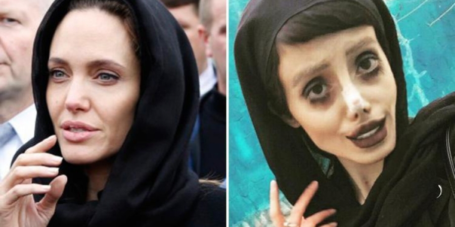Teen has 50 operations to look like Angelina, ends up looking like a zombie instead