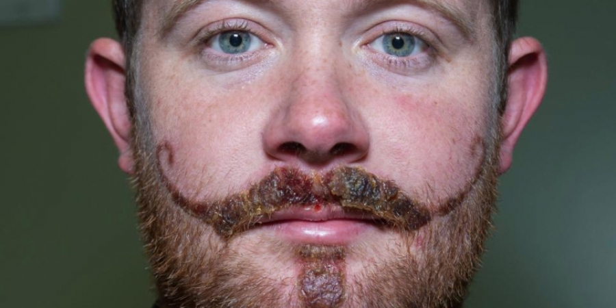 Man left with novelty moustache scar after severe allergic reaction to henna