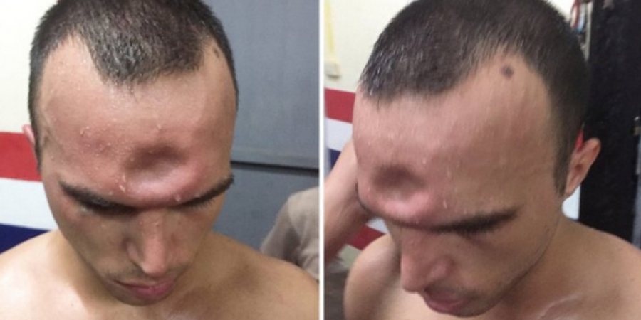 Muay Thai fighter suffers horrendous skull fracture during fight