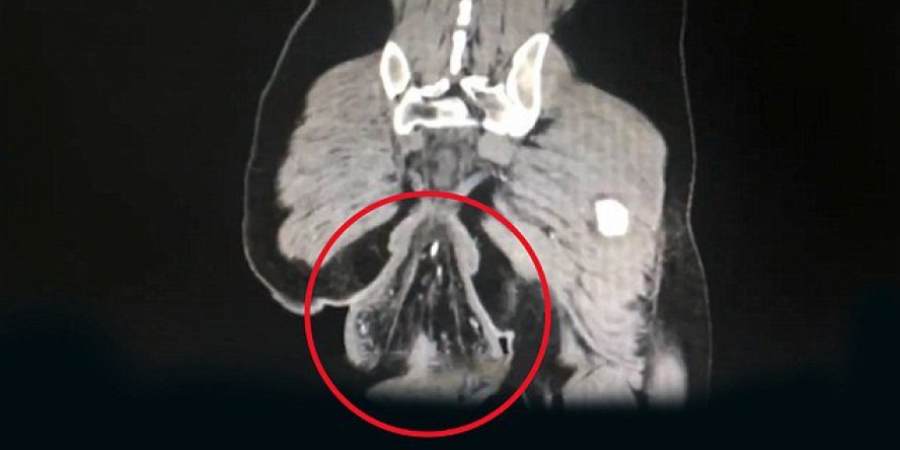 Dudes rectum falls out after sitting on the toilet for too long