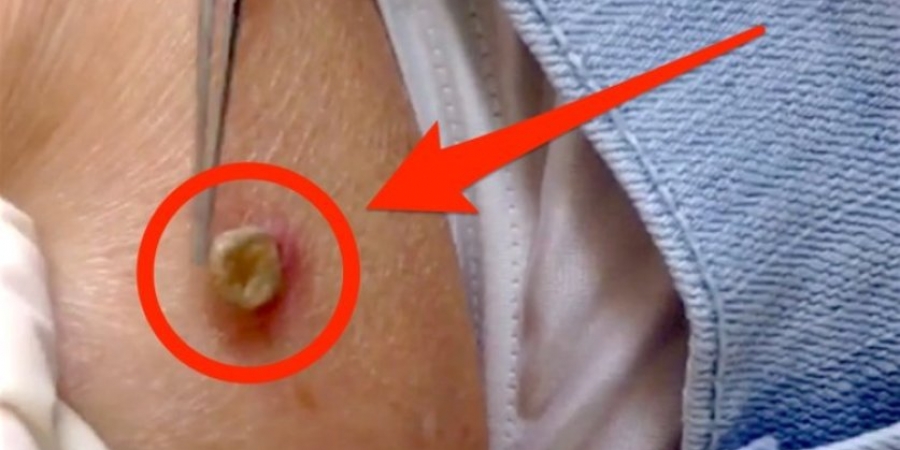 Dr Pimple Popper removes 'growth' that is actually alive!!!
