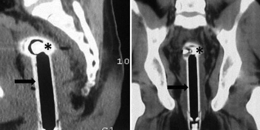 Dude rushed to hospital with shower head stuck up his ass, tells doctors he "fell"