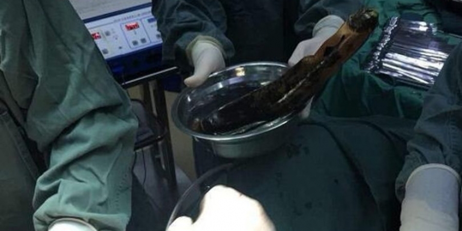 Doctors remove foot-long aubergine from guys intestines after he shoved it up his ass