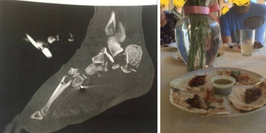 Guy served his mates tacos made from his amputated foot