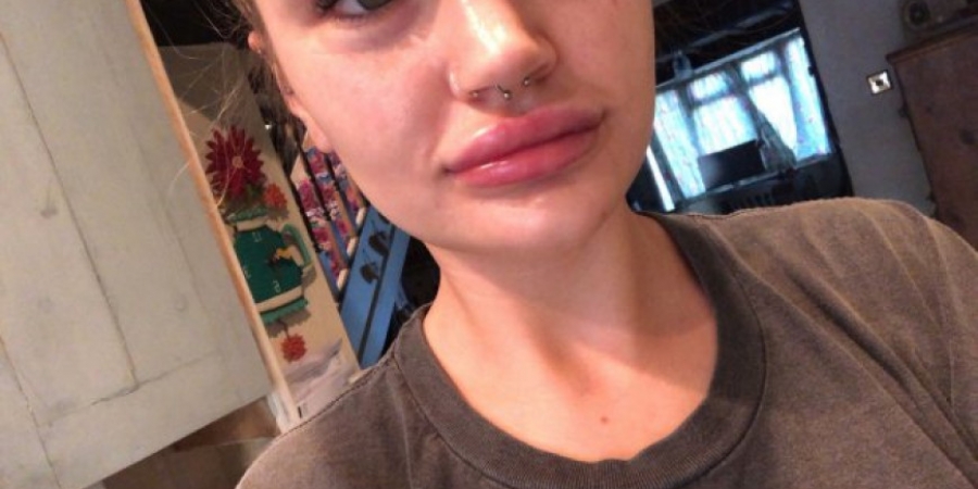 Clinic blames woman's botched lip filler on 'too many blowjobs'