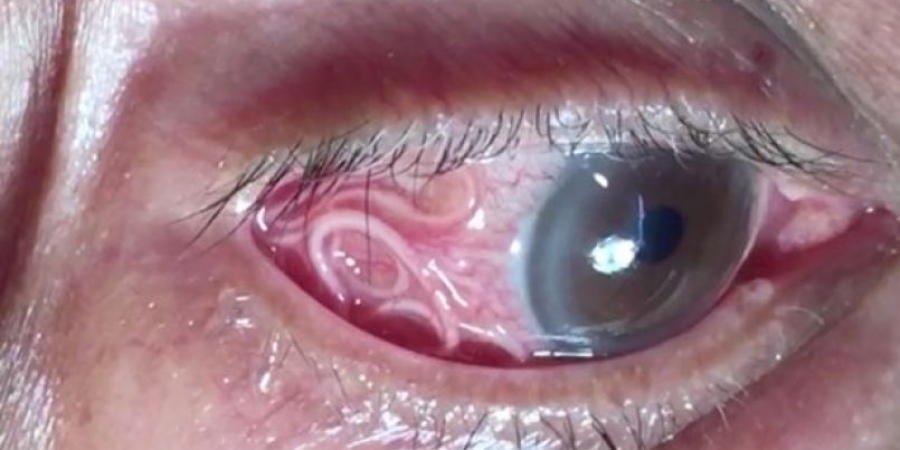 Dude has 15cm parasitic worm pulled from his eye