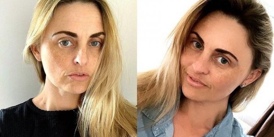 This woman faked depression to get a free nose job on the NHS