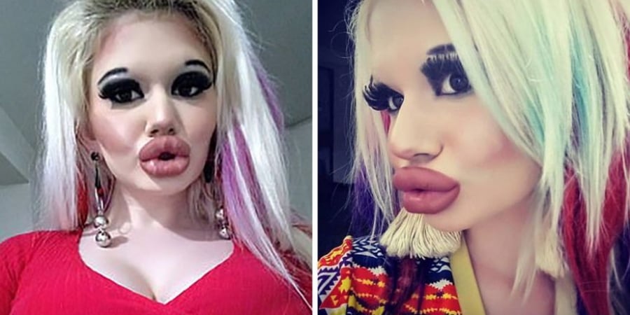Woman reckons she looks fit as fuck after tripling the size of her lips!