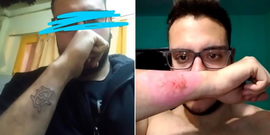 Dude uses cheese grater to remove his own arm tattoo!