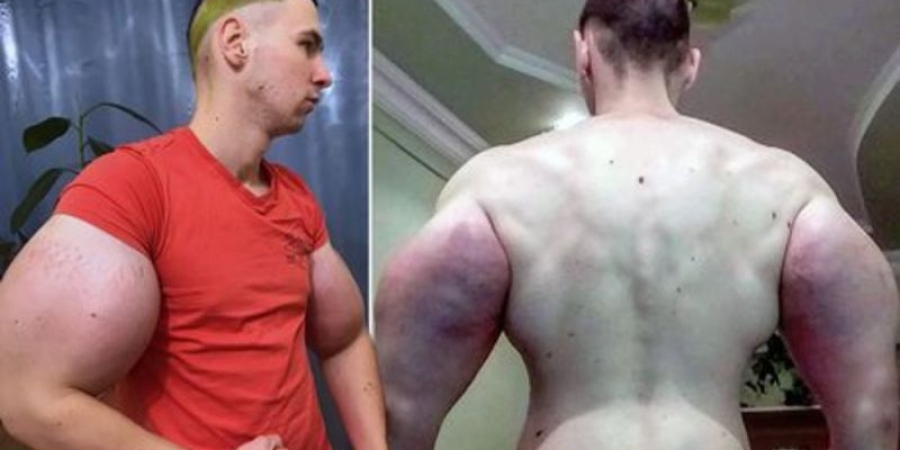 Dude boasts biggest arms in Russia after injecting them with oil