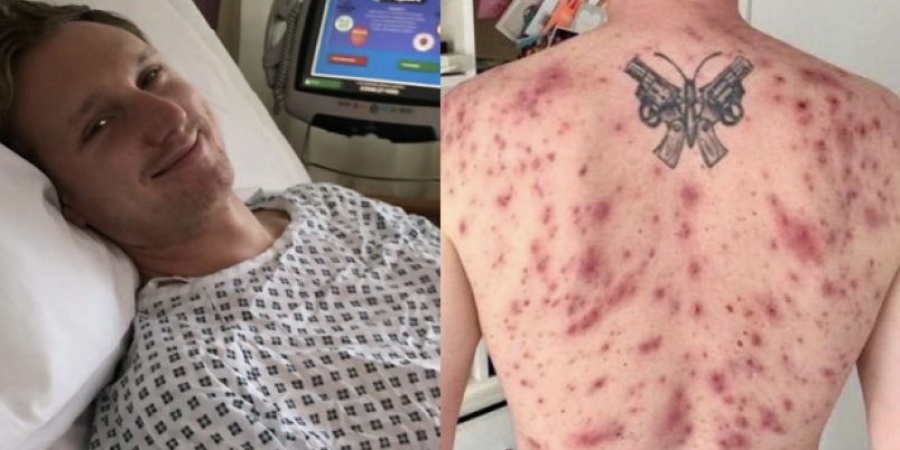 Dude nearly dies after parasitic worm swims up his penis & lays eggs