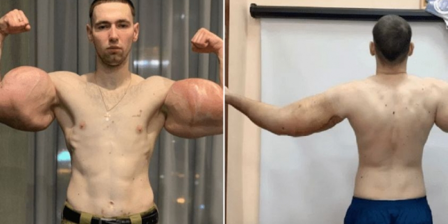 Russian bodybuilder 'Popeye' has 3lbs of rotten muscle removed from his biceps