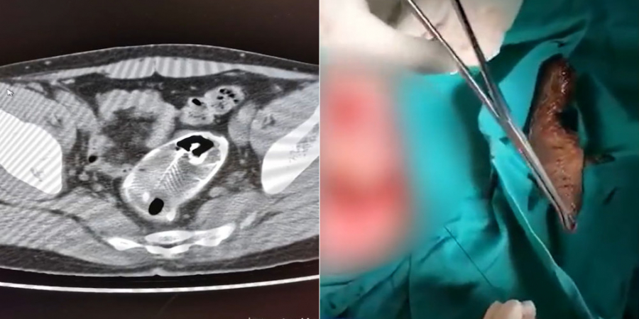 Dude has whole fish removed from rectum after 'accidentally' sitting on it