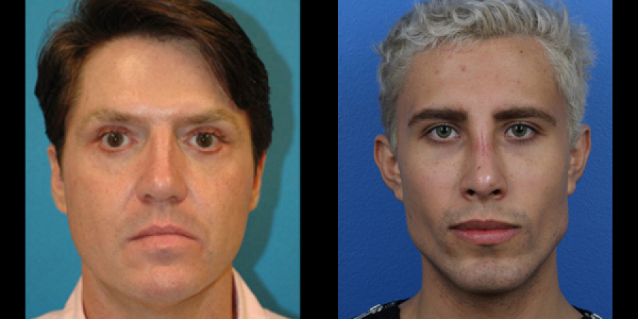 Dude has plastic surgery & name change so he can date his ex following restraining order
